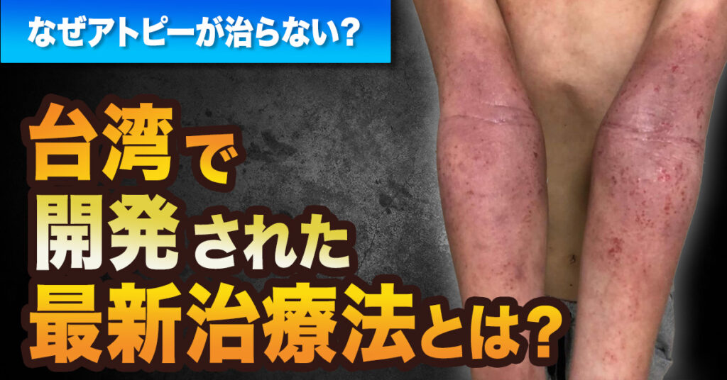 【9月24日(日)14時～】なぜアトピーが治らない？台湾で開発された最新治療法とは？